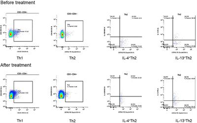 Case Report: The Application of Dupilumab in Atopic Dermatitis Children Complicated With Nephrotic Syndrome